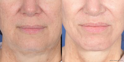 Lip Lift Before & After Gallery - Patient 110492 - Image 1
