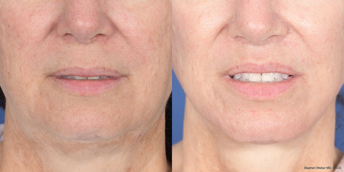 Lip Lift Before & After Gallery - Patient 110492 - Image 2