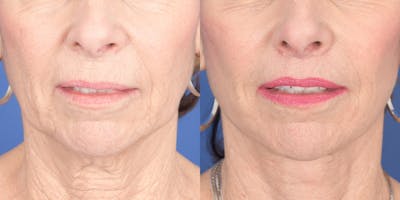 Lip Lift Before & After Gallery - Patient 693485 - Image 1