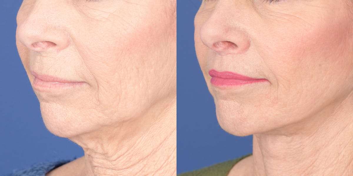 Lip Lift Before & After Gallery - Patient 693485 - Image 2