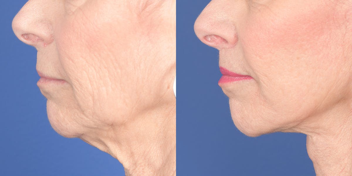 Lip Lift Before & After Gallery - Patient 693485 - Image 3
