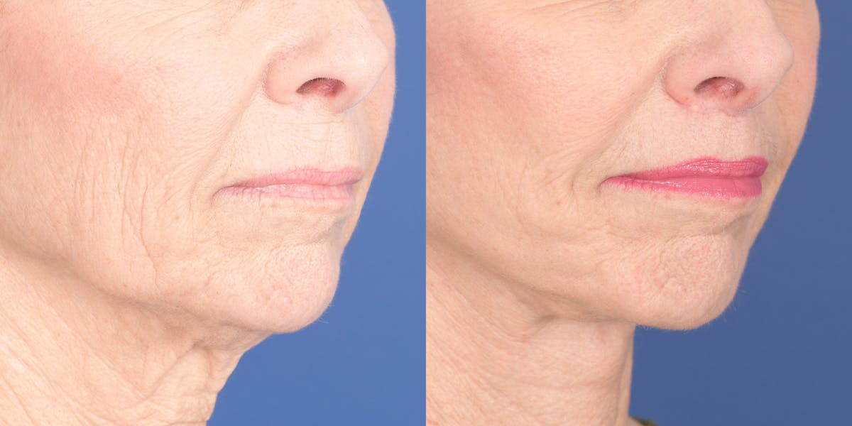 Lip Lift Before & After Gallery - Patient 693485 - Image 4