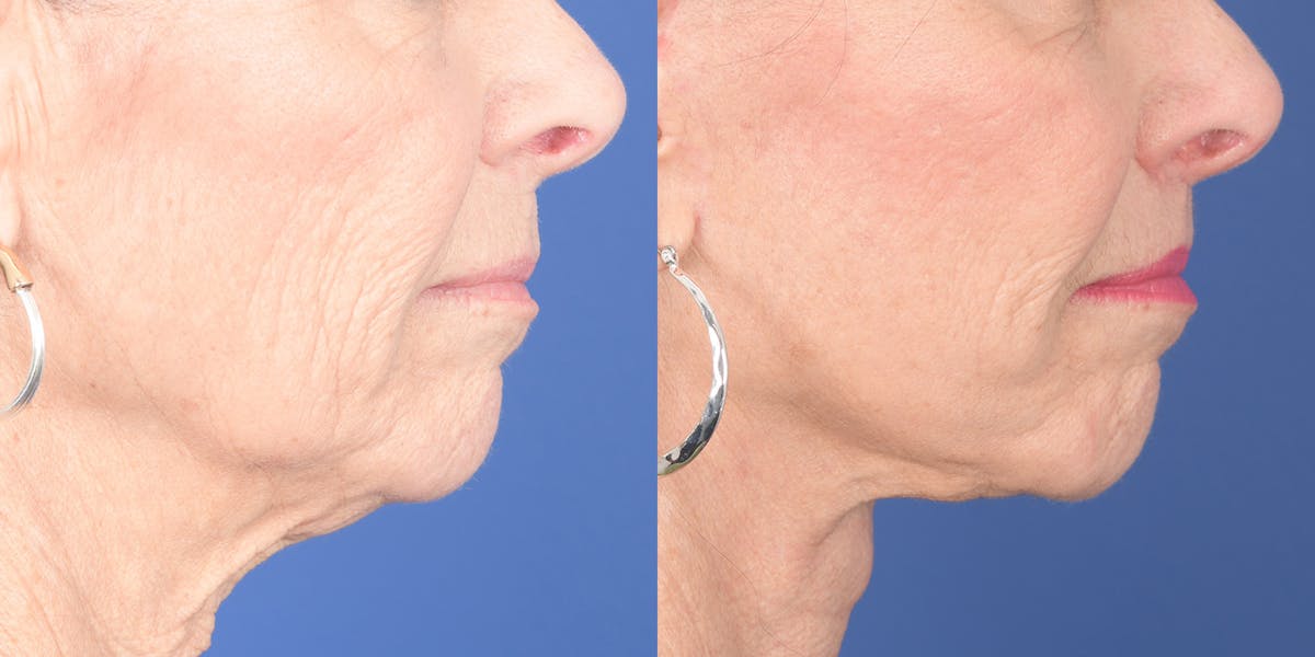 Lip Lift Before & After Gallery - Patient 693485 - Image 5