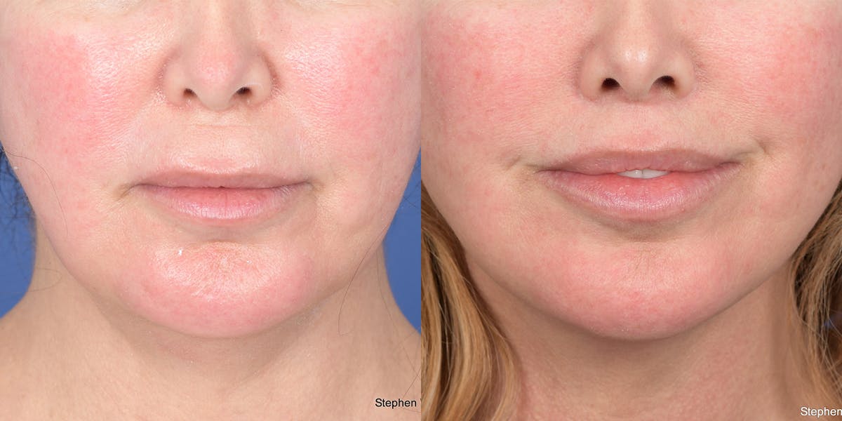 Lip Lift Before & After Gallery - Patient 398392 - Image 1