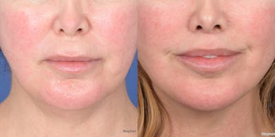 Lip Lift Before & After Gallery - Patient 398392 - Image 1