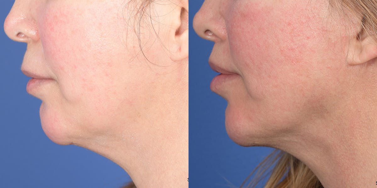 Lip Lift Before & After Gallery - Patient 398392 - Image 2