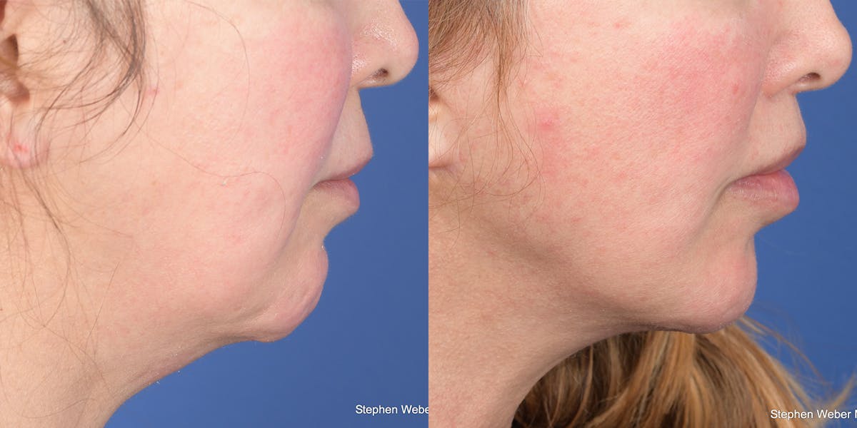 Lip Lift Before & After Gallery - Patient 398392 - Image 3