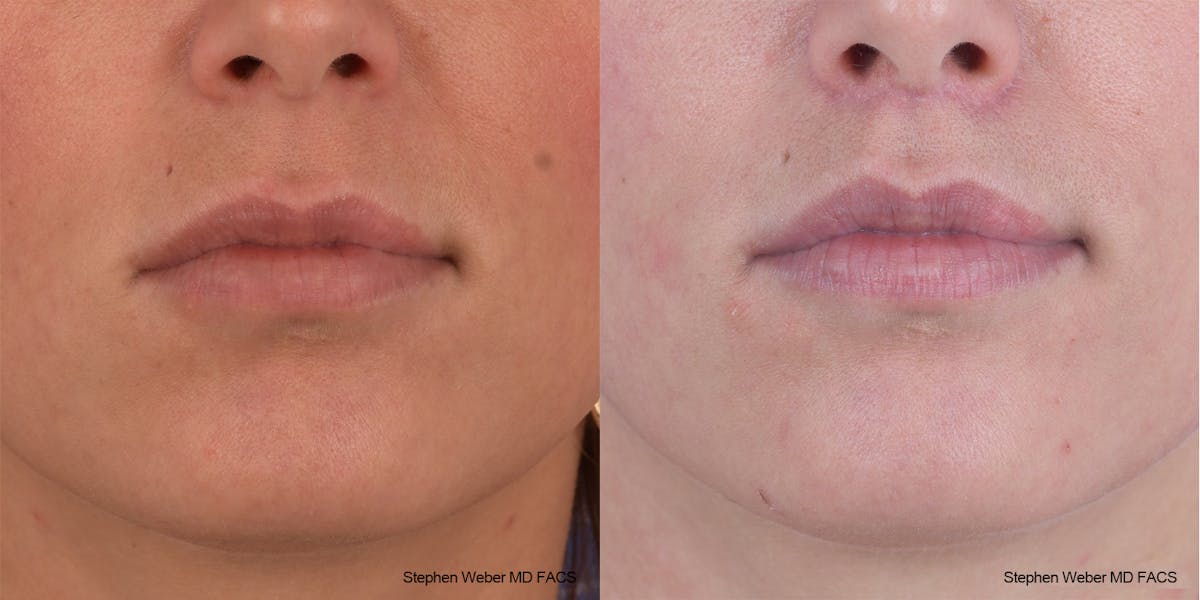Lip Lift Before & After Gallery - Patient 369230 - Image 1