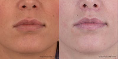 Lip Lift Before & After Gallery - Patient 369230 - Image 1