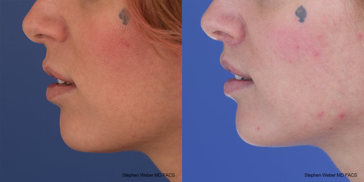 Lip Lift Before & After Gallery - Patient 369230 - Image 2