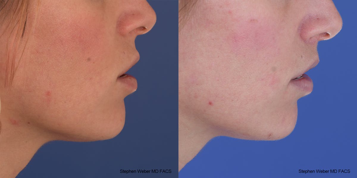 Lip Lift Before & After Gallery - Patient 369230 - Image 3