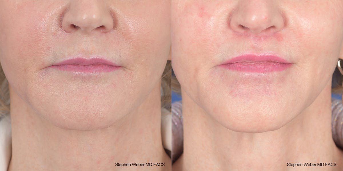 Lip Lift Before & After Gallery - Patient 162446 - Image 1
