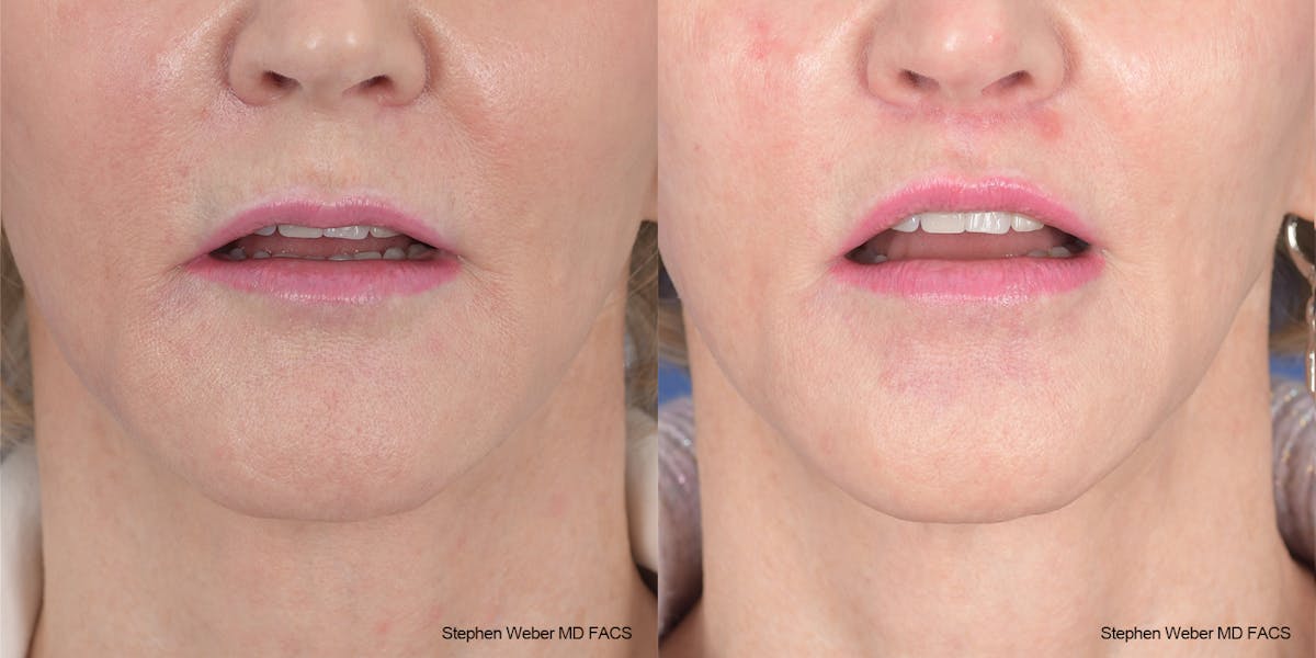 Lip Lift Before & After Gallery - Patient 162446 - Image 2