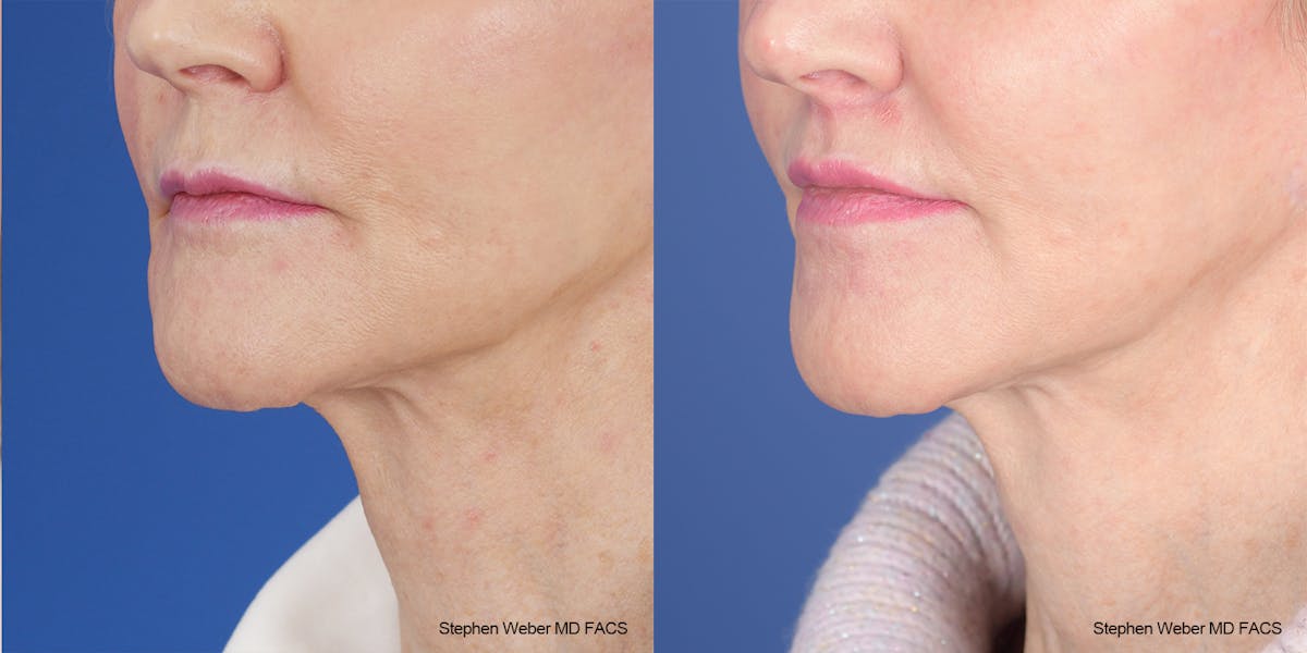 Lip Lift Before & After Gallery - Patient 162446 - Image 3