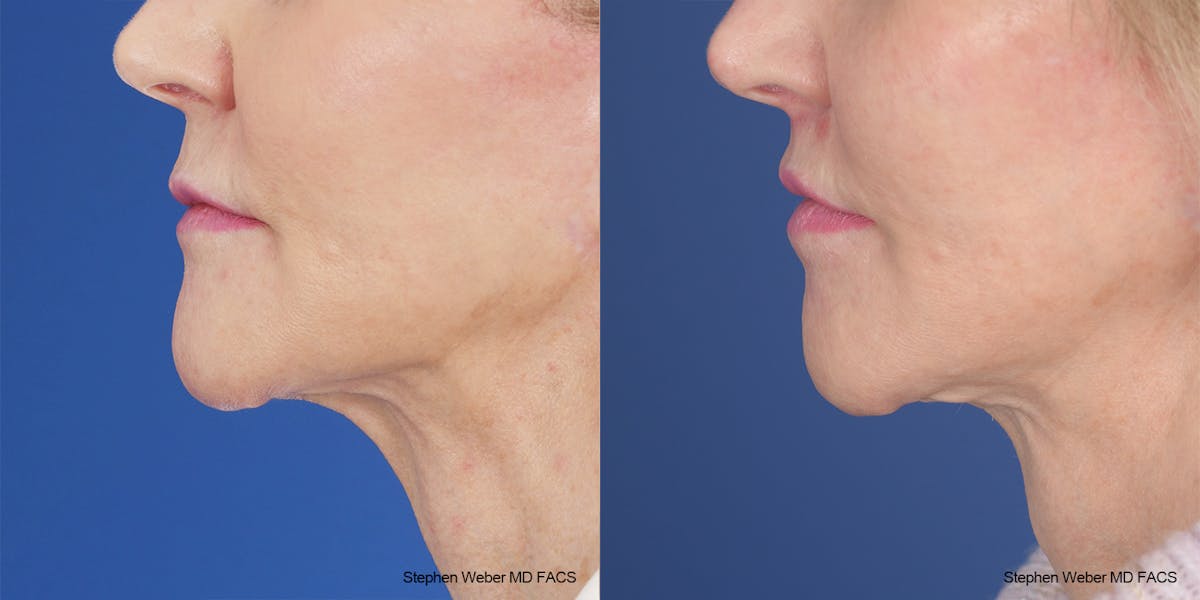 Lip Lift Before & After Gallery - Patient 162446 - Image 4
