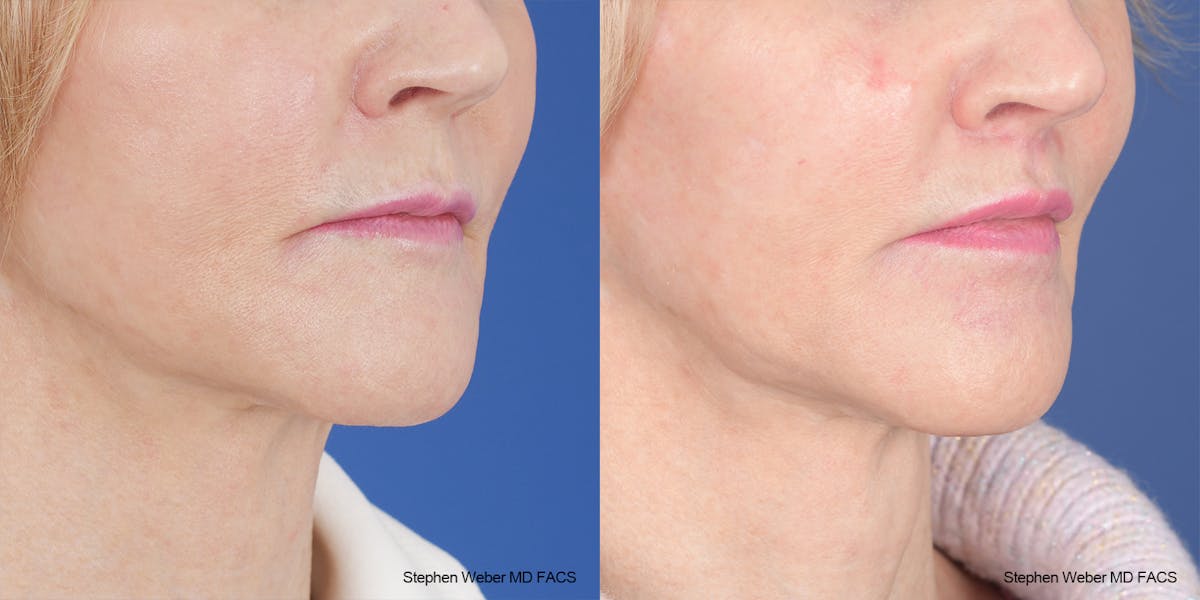 Lip Lift Before & After Gallery - Patient 162446 - Image 5