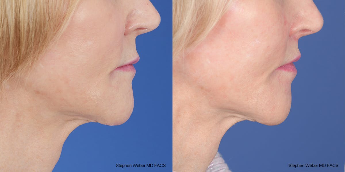 Lip Lift Before & After Gallery - Patient 162446 - Image 6
