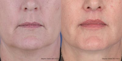 Lip Lift Before & After Gallery - Patient 396047 - Image 1