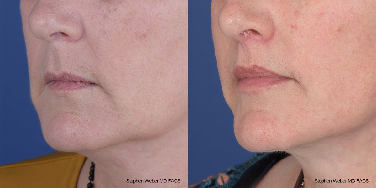 Lip Lift Before & After Gallery - Patient 396047 - Image 2