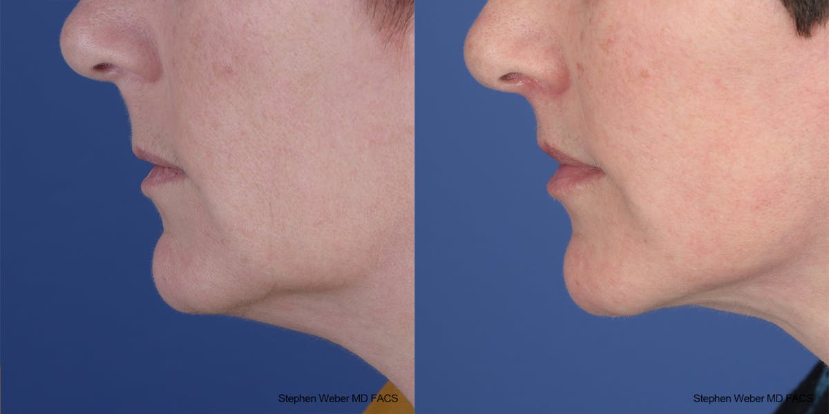 Lip Lift Before & After Gallery - Patient 396047 - Image 3