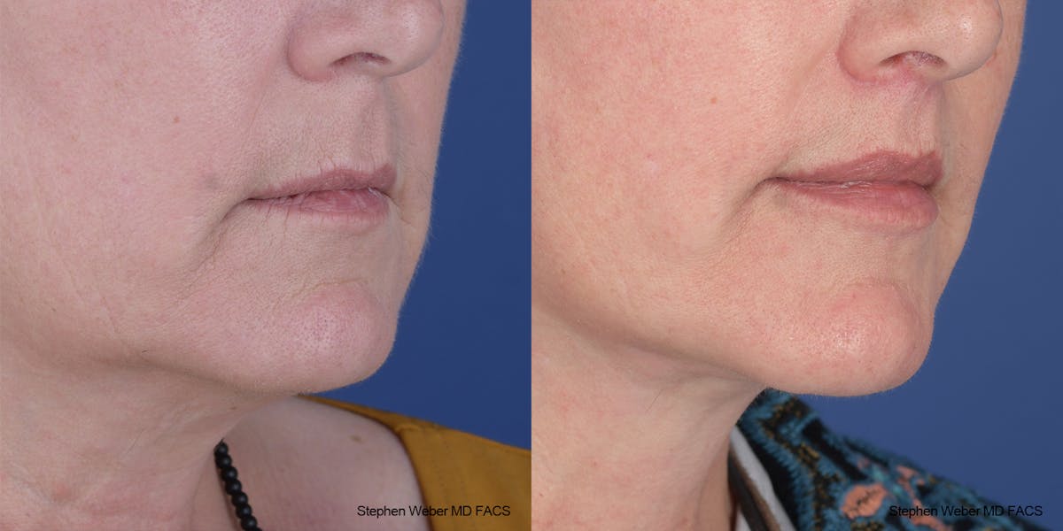 Lip Lift Before & After Gallery - Patient 396047 - Image 4