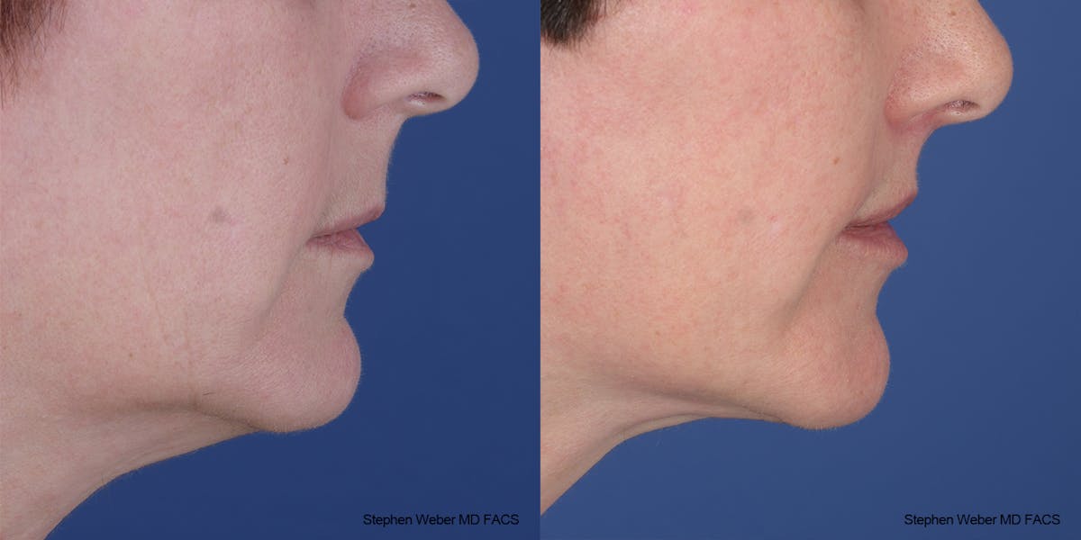 Lip Lift Before & After Gallery - Patient 396047 - Image 5