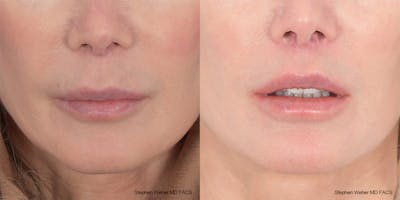 Lip Lift Before & After Gallery - Patient 176037 - Image 1