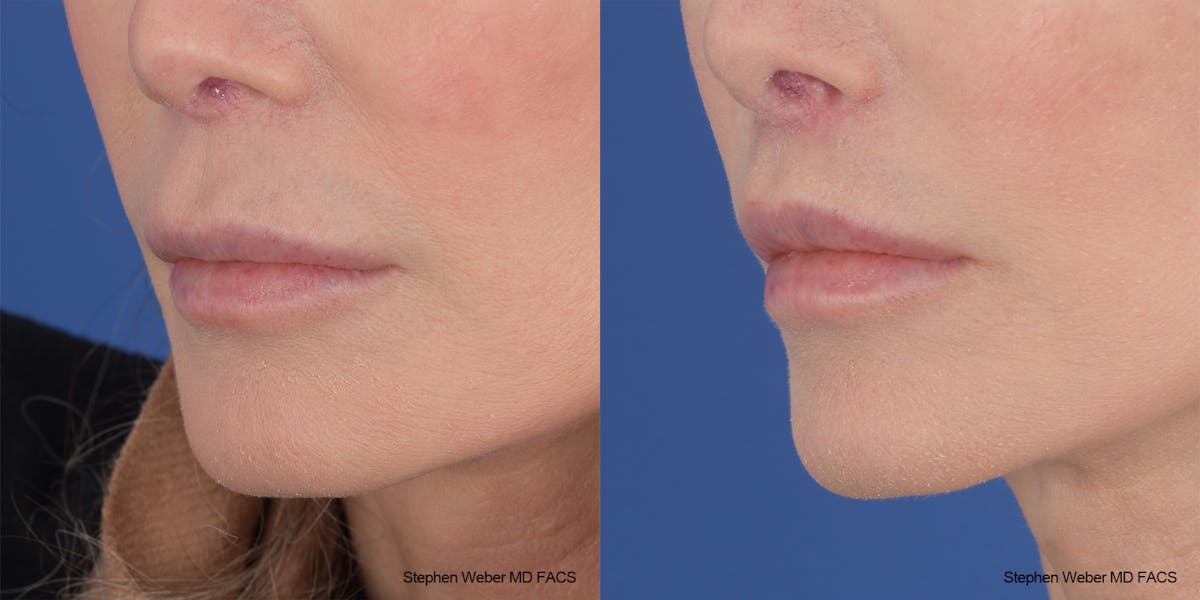 Lip Lift Before & After Gallery - Patient 176037 - Image 2