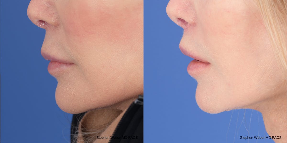 Lip Lift Before & After Gallery - Patient 176037 - Image 3