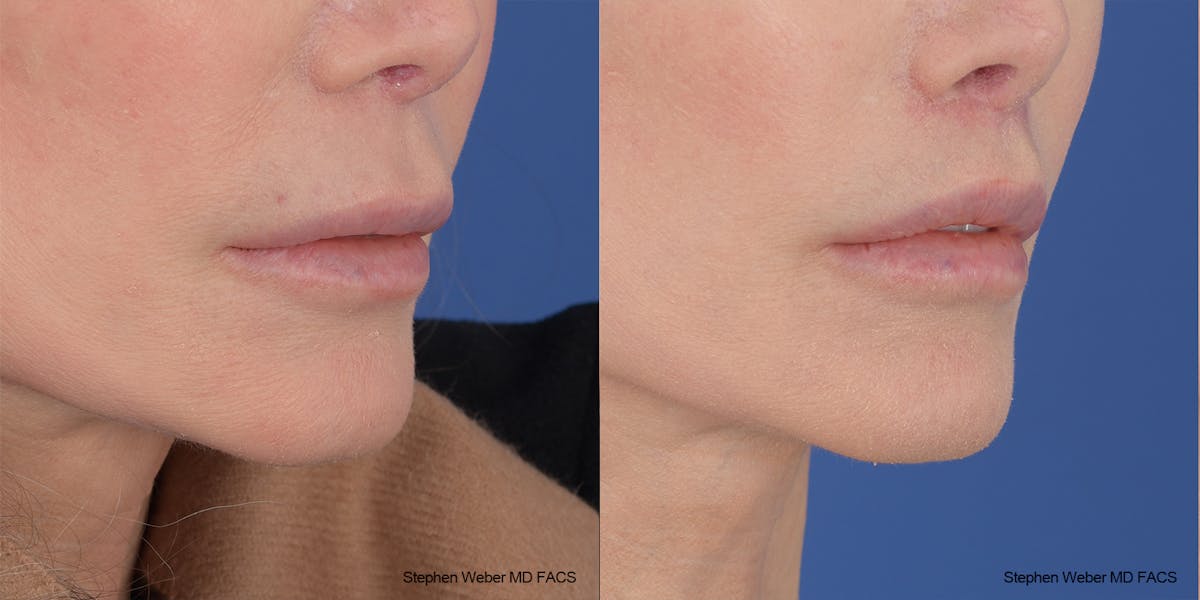 Lip Lift Before & After Gallery - Patient 176037 - Image 4