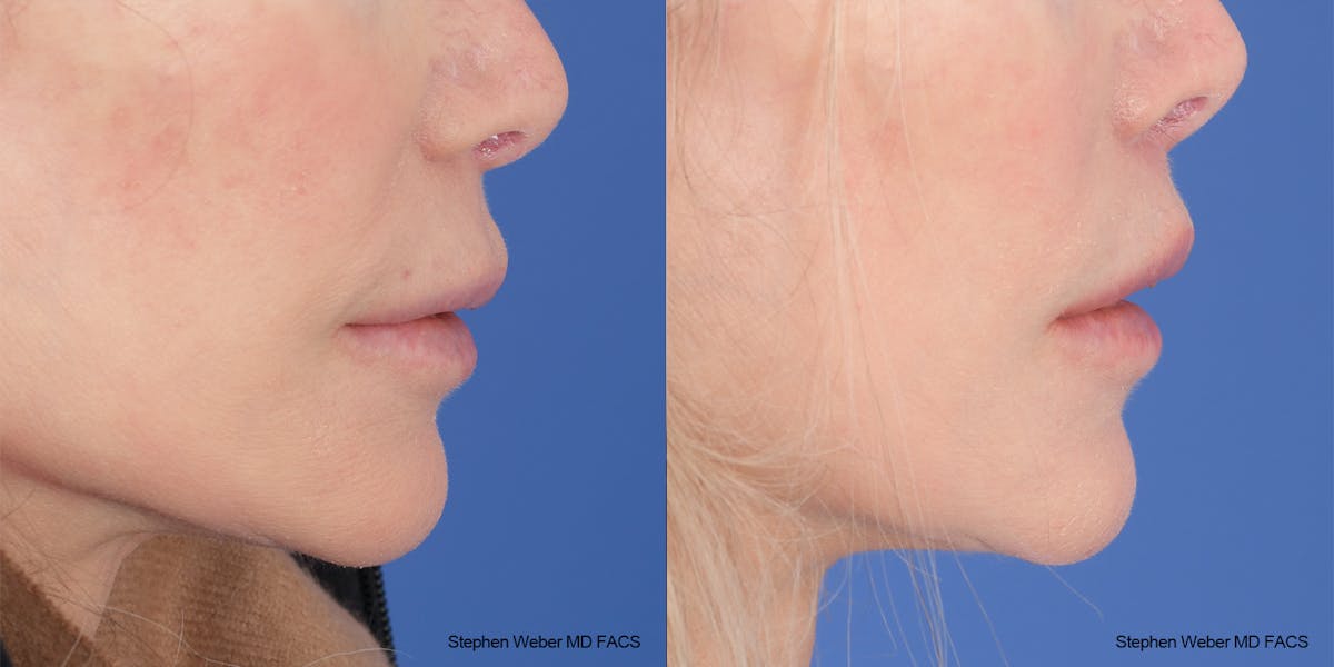 Lip Lift Before & After Gallery - Patient 176037 - Image 5