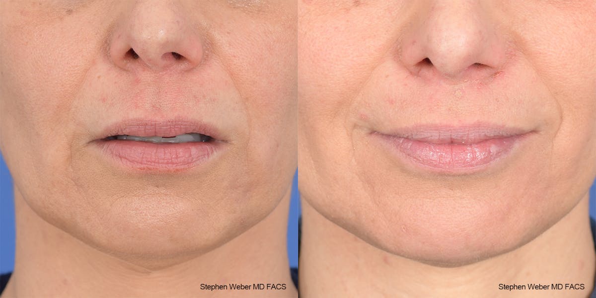 Lip Lift Before & After Gallery - Patient 376414 - Image 1