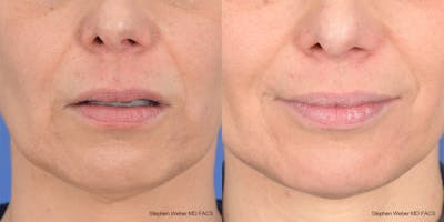 Lip Lift Before & After Gallery - Patient 376414 - Image 1