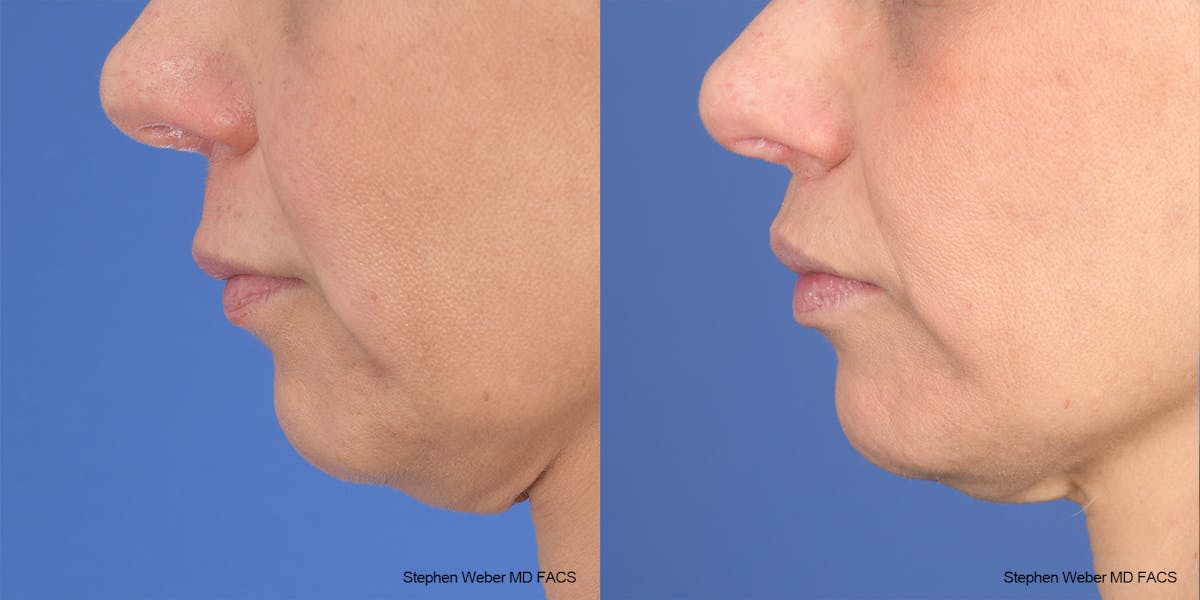 Lip Lift Before & After Gallery - Patient 376414 - Image 2