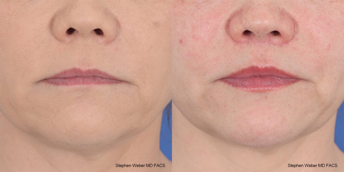 Lip Lift Before & After Gallery - Patient 145167 - Image 1