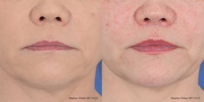 Lip Lift Before & After Gallery - Patient 145167 - Image 1
