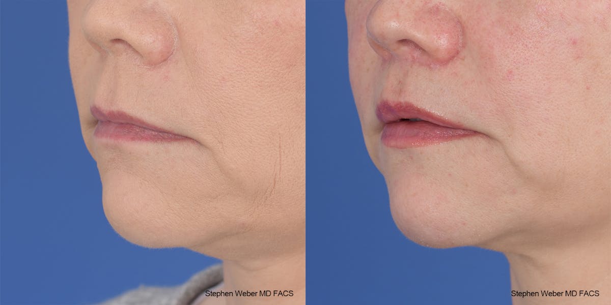 Lip Lift Before & After Gallery - Patient 145167 - Image 2