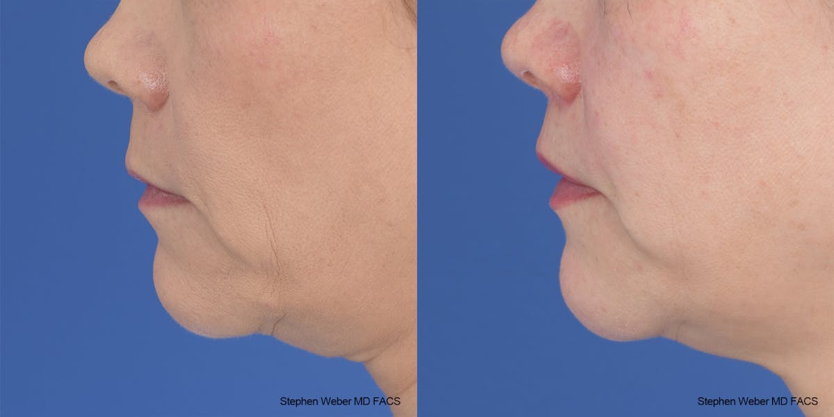 Lip Lift Before & After Gallery - Patient 145167 - Image 3
