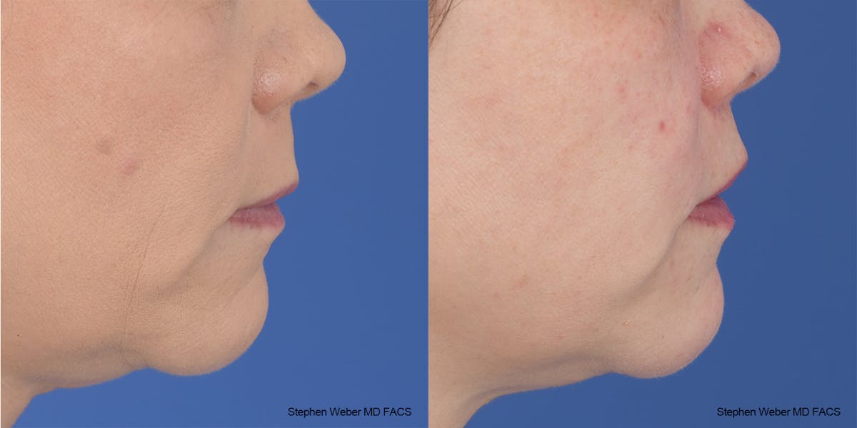 Lip Lift Before & After Gallery - Patient 145167 - Image 5