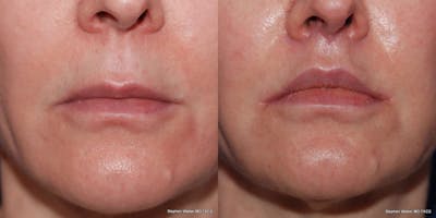 Lip Lift Before & After Gallery - Patient 369370 - Image 1