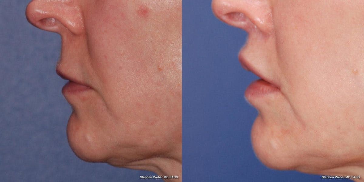 Lip Lift Before & After Gallery - Patient 369370 - Image 2
