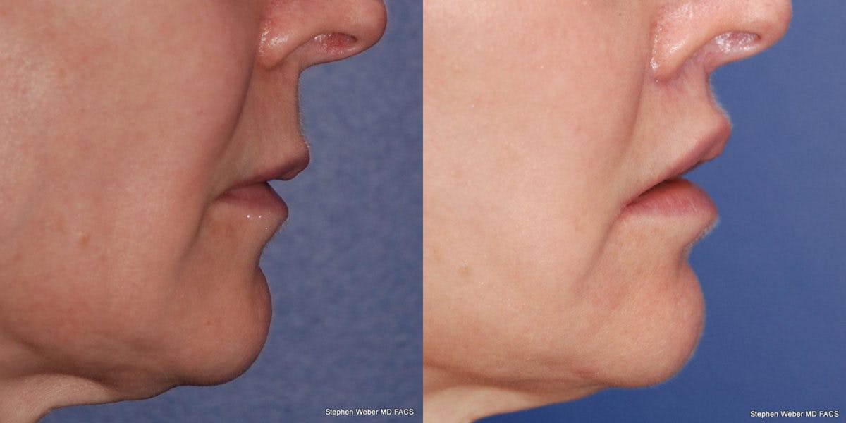 Lip Lift Before & After Gallery - Patient 369370 - Image 3