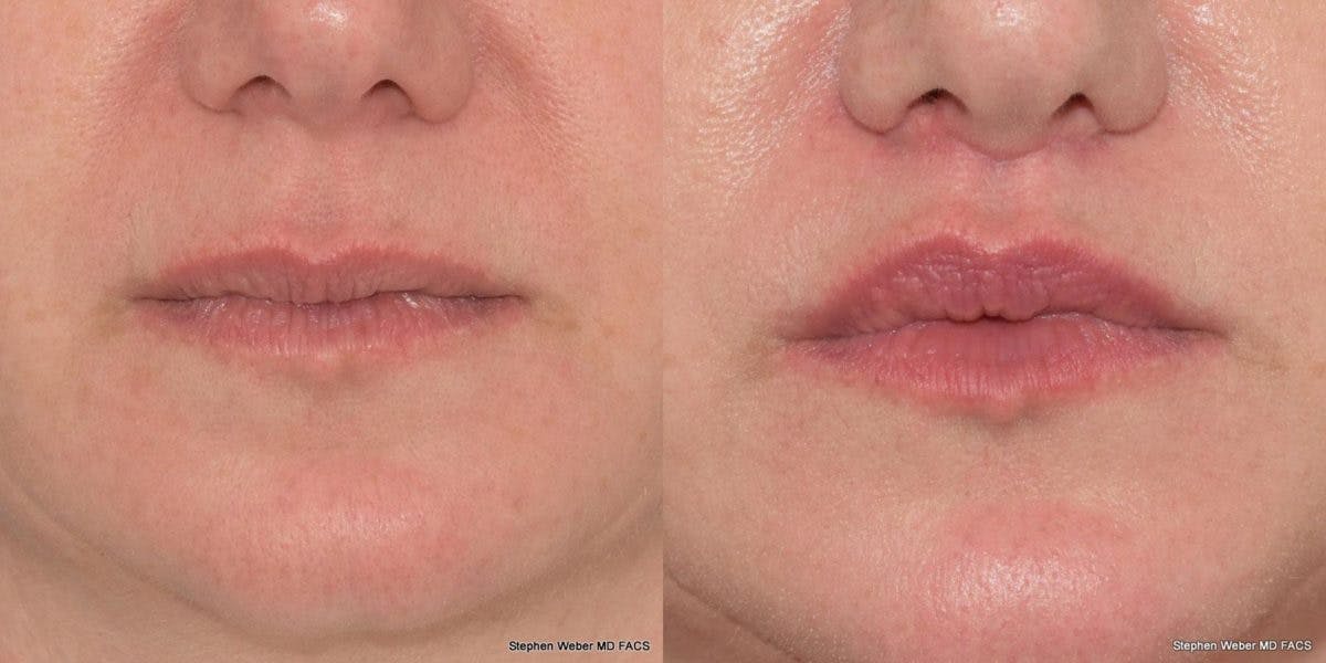 Lip Lift Before & After Gallery - Patient 149832 - Image 1