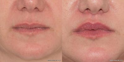 Lip Lift Before & After Gallery - Patient 149832 - Image 1