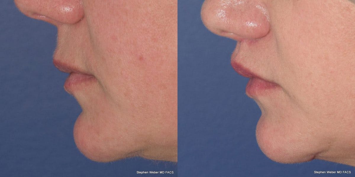 Lip Lift Before & After Gallery - Patient 149832 - Image 2
