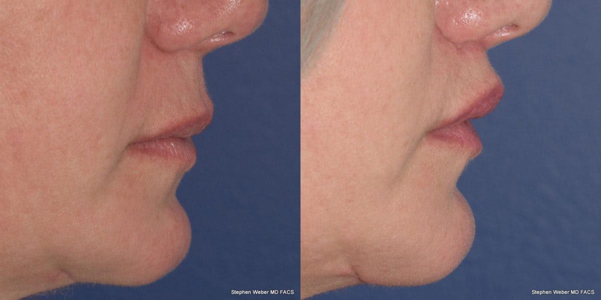 Lip Lift Before & After Gallery - Patient 149832 - Image 3