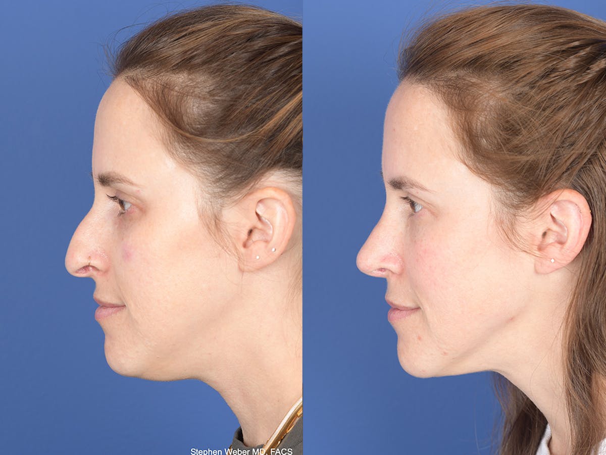 Liposuction Before & After Gallery - Patient 291482 - Image 2