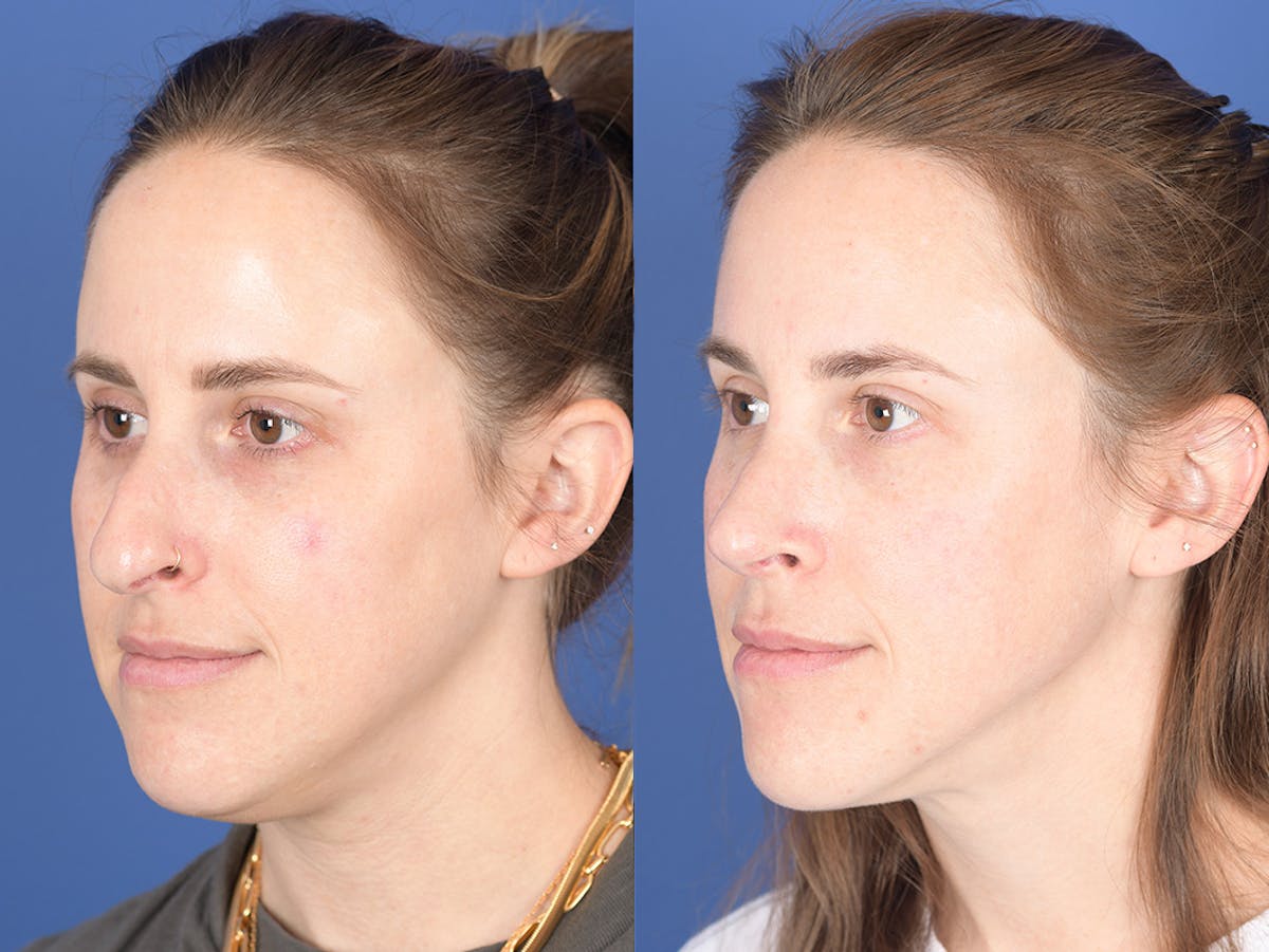 Liposuction Before & After Gallery - Patient 291482 - Image 3