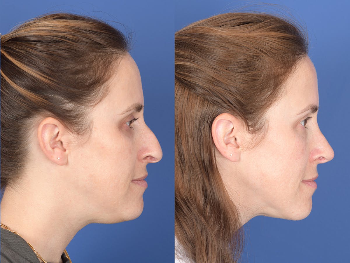 Liposuction Before & After Gallery - Patient 291482 - Image 4