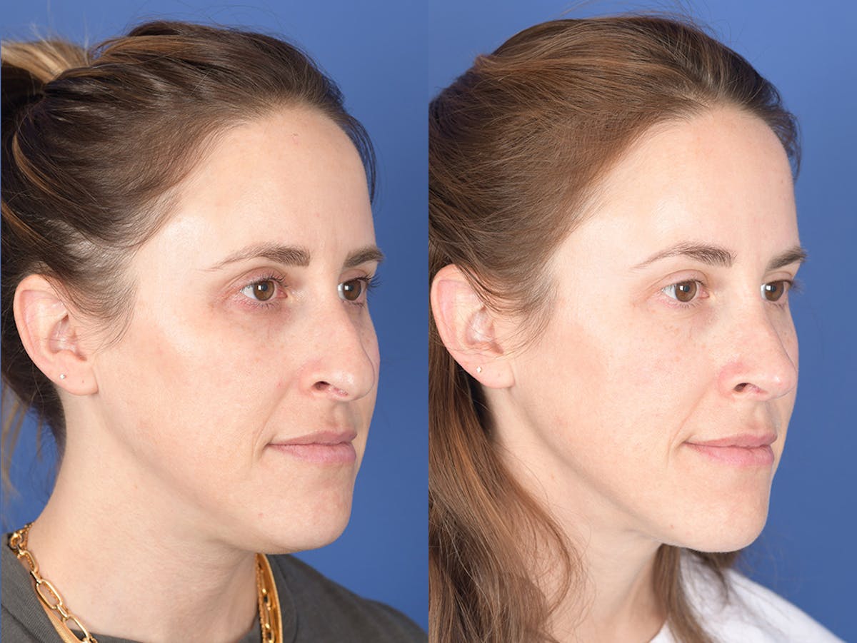 Liposuction Before & After Gallery - Patient 291482 - Image 5